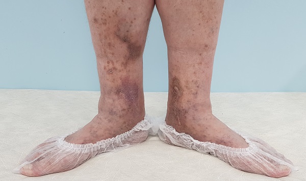 потемнение кожи при варикозной болезни (гиперпигментация)