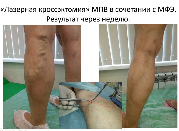 Доклад флеболога из Москвы Кургиняна Х.М.
