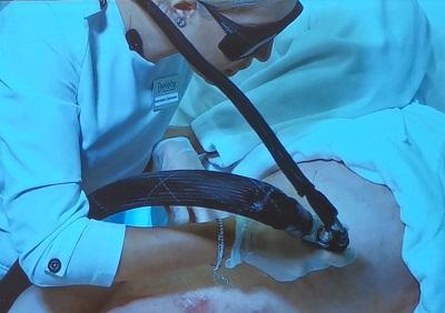 Мастер-класс по лазерному удалению сосудистых звёздочек от врача косметолога Поповой А.Ю.