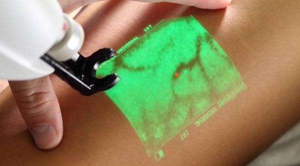 Использование Vein Viewer для улучшения визуализации сосудов