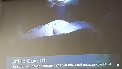 Аттилио Кавецци проводит эндоваскулярное вмешательство