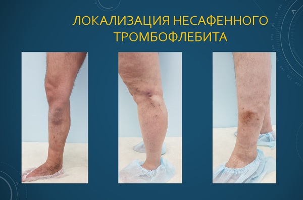 Локализация несафенного тромбофлебита
