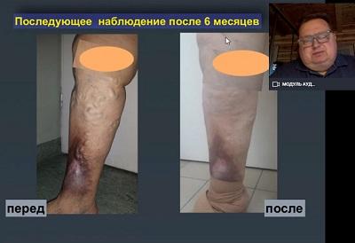 Результаты механохимической облитерации Flebogrif