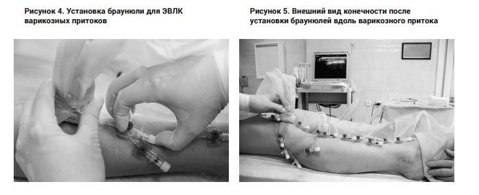Этапы выполнения лазерной коагуляции притоков при Тотал ЭВЛК