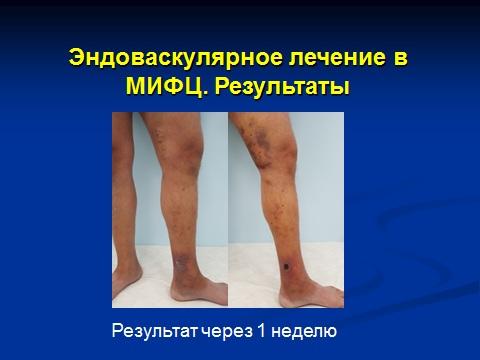 Результат лазерного лечения открытой трофической язвы через 7 дней после вмешательства. Язва полностью зажила.
