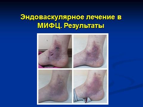 хороший результат лечения трофической язвы, который мы получили через 2 месяца после эндовазальной лазерной облитерации.
