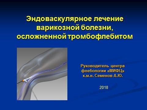 эндоваскулярное лечение варикозной болезни, осложнённое тромбофлебитом