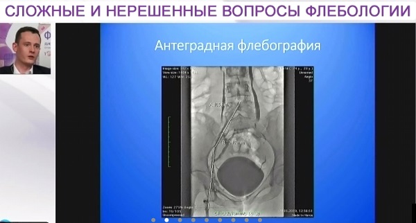 Phlebologists Club of Moscow 02 12 Iashkin 1