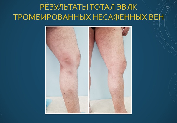Результат Тотал ЭВЛК тромбированных несафенных вен