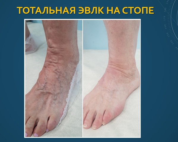 Результат тотальной лазерной коагуляции вен на стопе