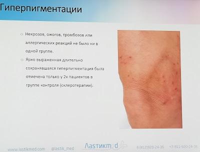 Гиперпигментация после процедуры LASTIK минимальная