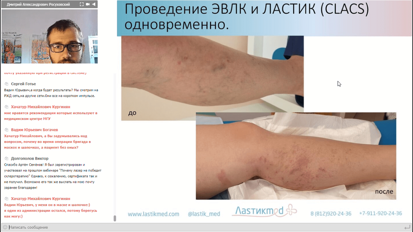 Проведение ЭВЛК и ЛАСТИК (CLACS) одновременно