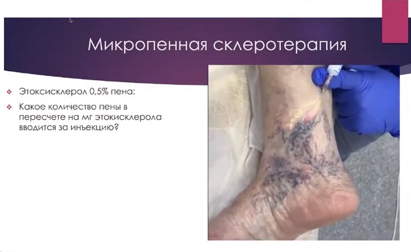 «Лазер vs Склеротерапия. Что выбрать: неодимовый лазер или склеротерапию?» - докладывает Периков М.А. (Санкт-Петербург)