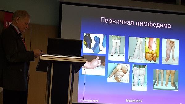 Пациенты доктора Franz-Josef Schingale (Германия) с первичной лимфедемой