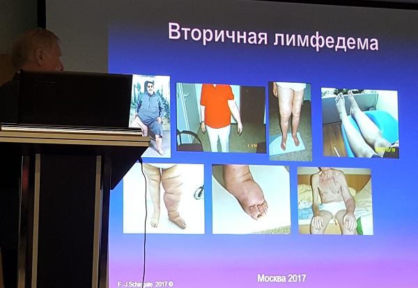 Пациенты доктора Franz-Josef Schingale (Германия) с вторичной лимфедемой