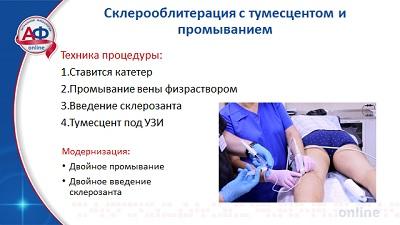 Пенная эхо-склерооблитерация с тумесцентом и промыванием