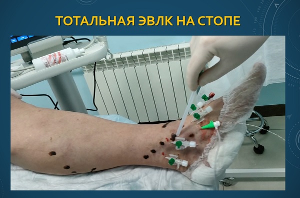 Тотальная лазерная коагуляция вен на стопе