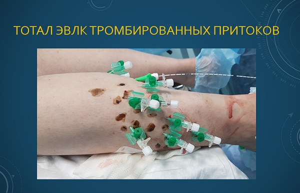Тотальная лазерная коагуляция тромбированных несафенных вен