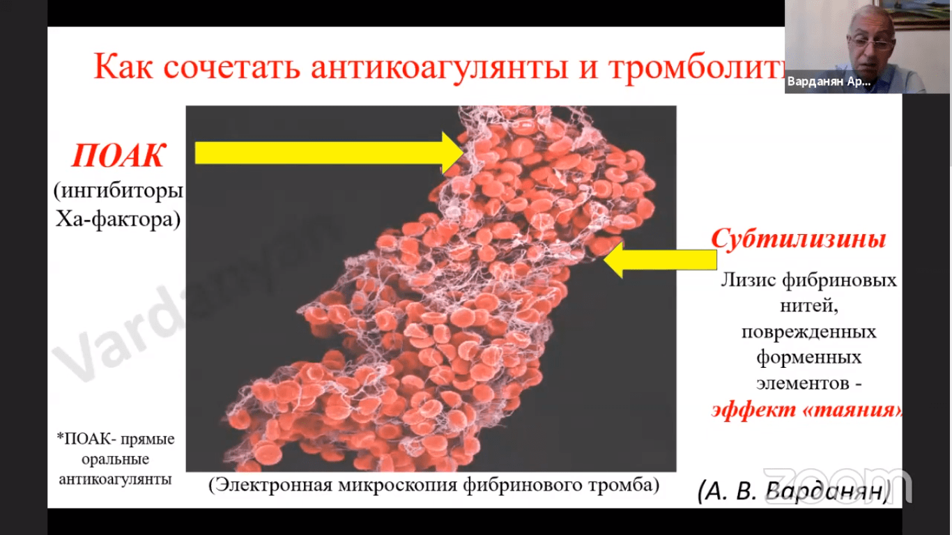 «Синдром Педжет-Шреттера: современный взгляд на старую проблему» - доклад профессора Варданяна А.В.