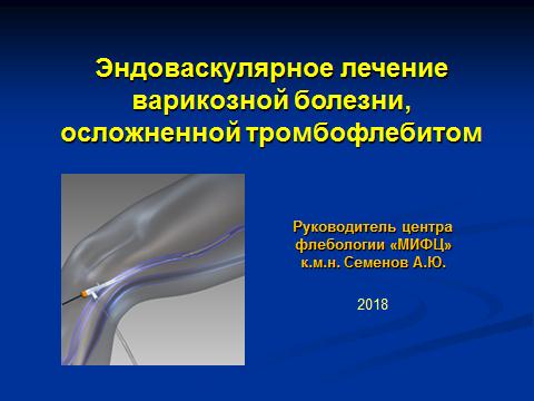 Эндоваскулярное лечение варикозной болезни, осложнённой тромбофлебитом