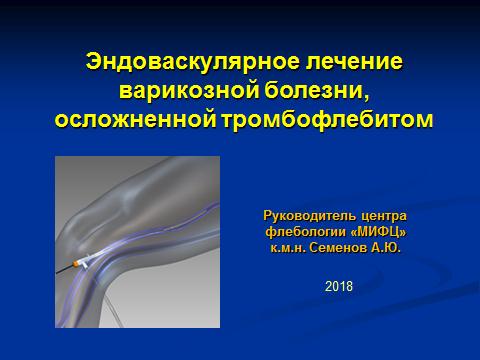 Лечение варикозной болезни, осложненной острым тромбозом поверхностных вен