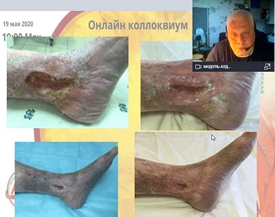 Амбулаторная хирургия трофических язв &ndash; докладывает Якушкин С.Н. (Москва)