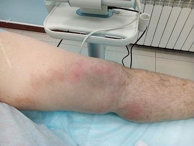 Лечение тромбофлебита методом ЭВЛК в нашем НИИ флебологии
