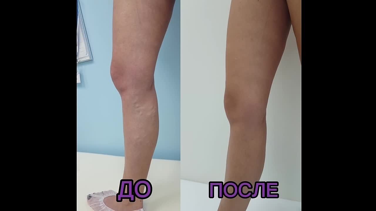Результат тотальной лазерной коагуляции у нашей пациентки через 7 месяцев после вмешательства