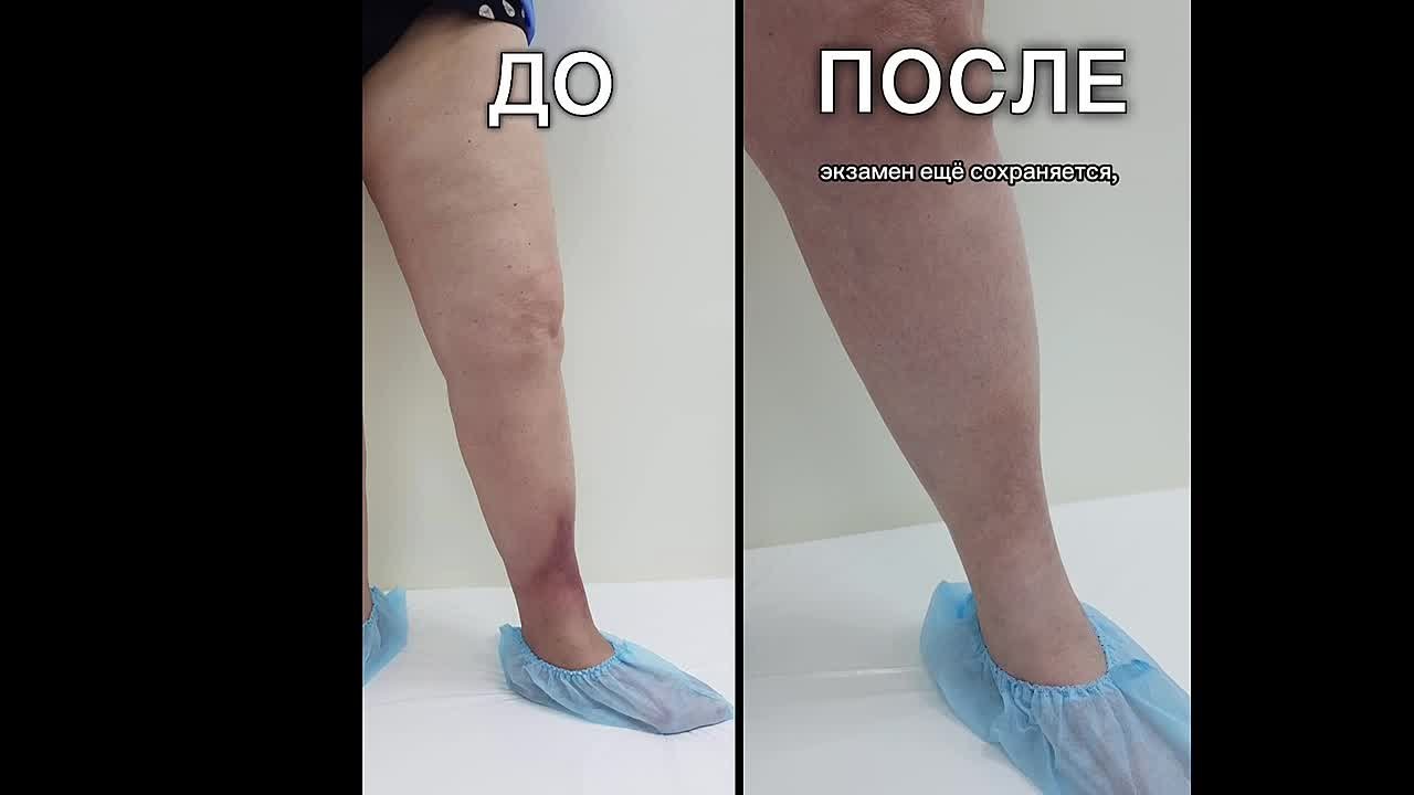     Видео трофической экземы после проведенного лазерного лечения через 1 год после вмешательства