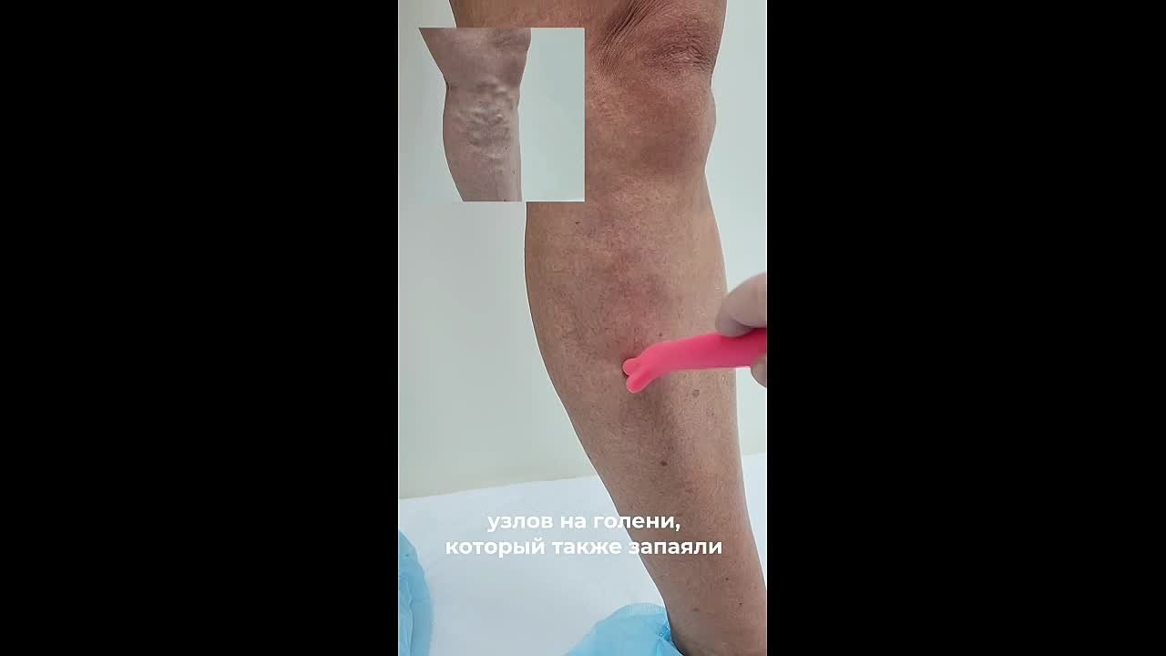 Прекрасный видео результат после тотальной ЭВЛК у пациентки через 7 месяцев после процедуры