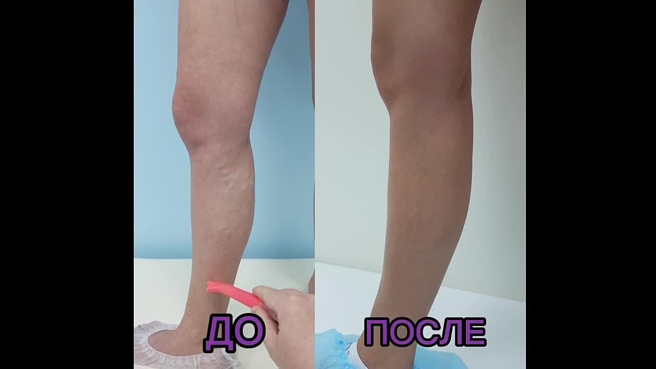 Как вылечить варикоз за одну процедуру методом тотал ЭВЛК