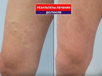 Месяц после тотальной ЭВЛК, а следов от вмешательства уже нет