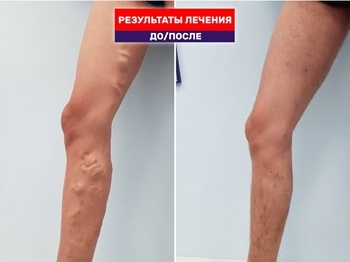 Видео результат как мы оперировали раньше, до появления Тотал ЭВЛК