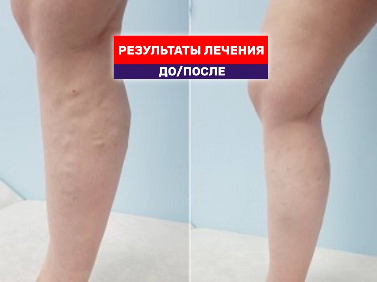 Видео результат лечения варикоза одновременно на дух нижних конечностях