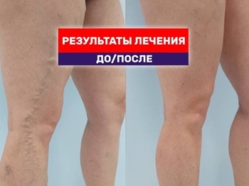Результат через пол года после устранения варикоза лазером