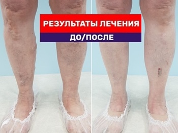 Видео результат после тотал ЭВЛК на двух ногах через 2 месяца