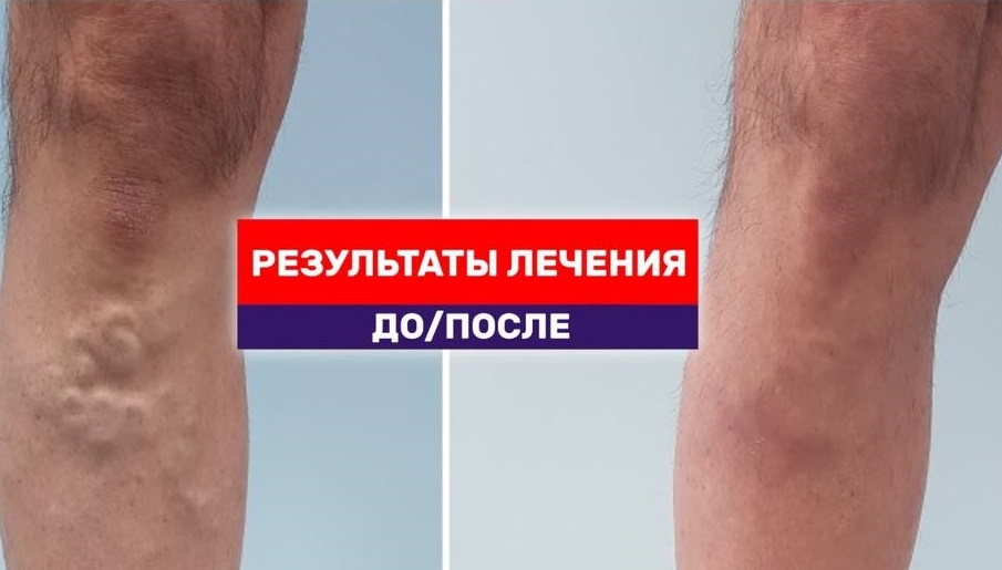 Результат лечения после устранения варикоза лазером через 3 недели после вмешательства