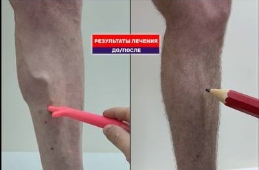 Вылечили варикоз молодому человеку. Видео результат через 3 месяца после лазерной процедуры