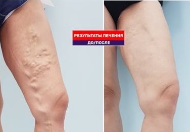 Как выглядят ноги через год после лазерной операции
