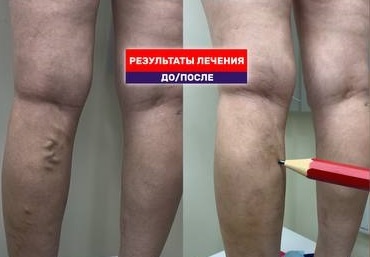 Результат лечения тромбоза лазером. Месяц после операции.