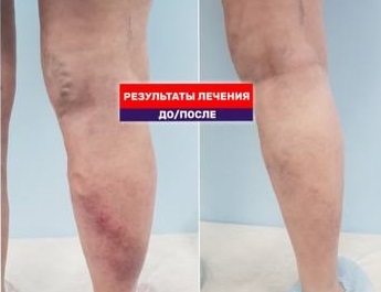 Великолепный результат лечения трофической венозной экземы на ноге