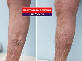 Результат лечения рецидива варикозной болезни лазером