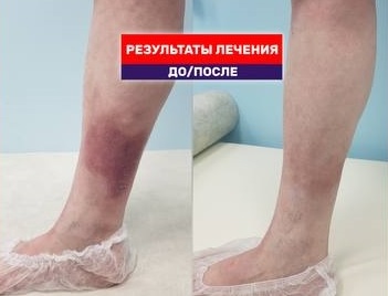 Как мы вылечили лазером темное пятно на ноге. История нашей пациентки