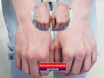 Как убрать некрасивые вены на руках. Видео результат удаления вен на кистях