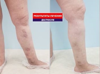 Кровотечение из варикозно расширенных вен на ноге. Результат через год после лазерной операции