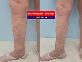 Вылечили варикоз лазером 81-летней пациентке с очень хорошим результатом