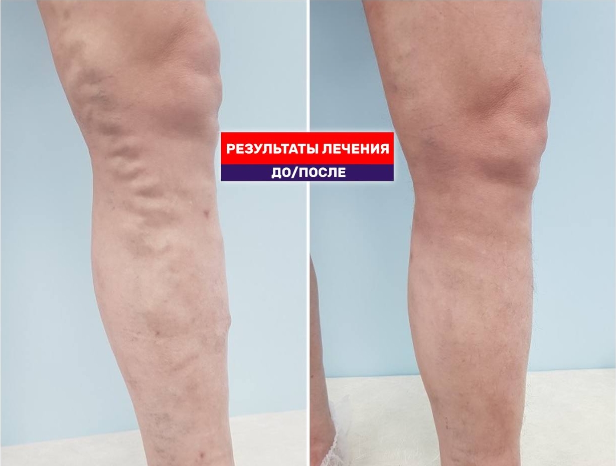 Результат до и после лечения. 3 месяца после тотальной ЭВЛК