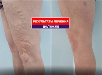 Результат лечения варикоза лазером. Месяц после тотал ЭВЛК