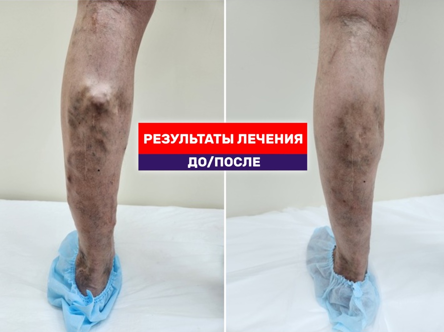 От лампасных разрезов к тотал ЭВЛК: один и тот же пациент, две эпохи флебологии