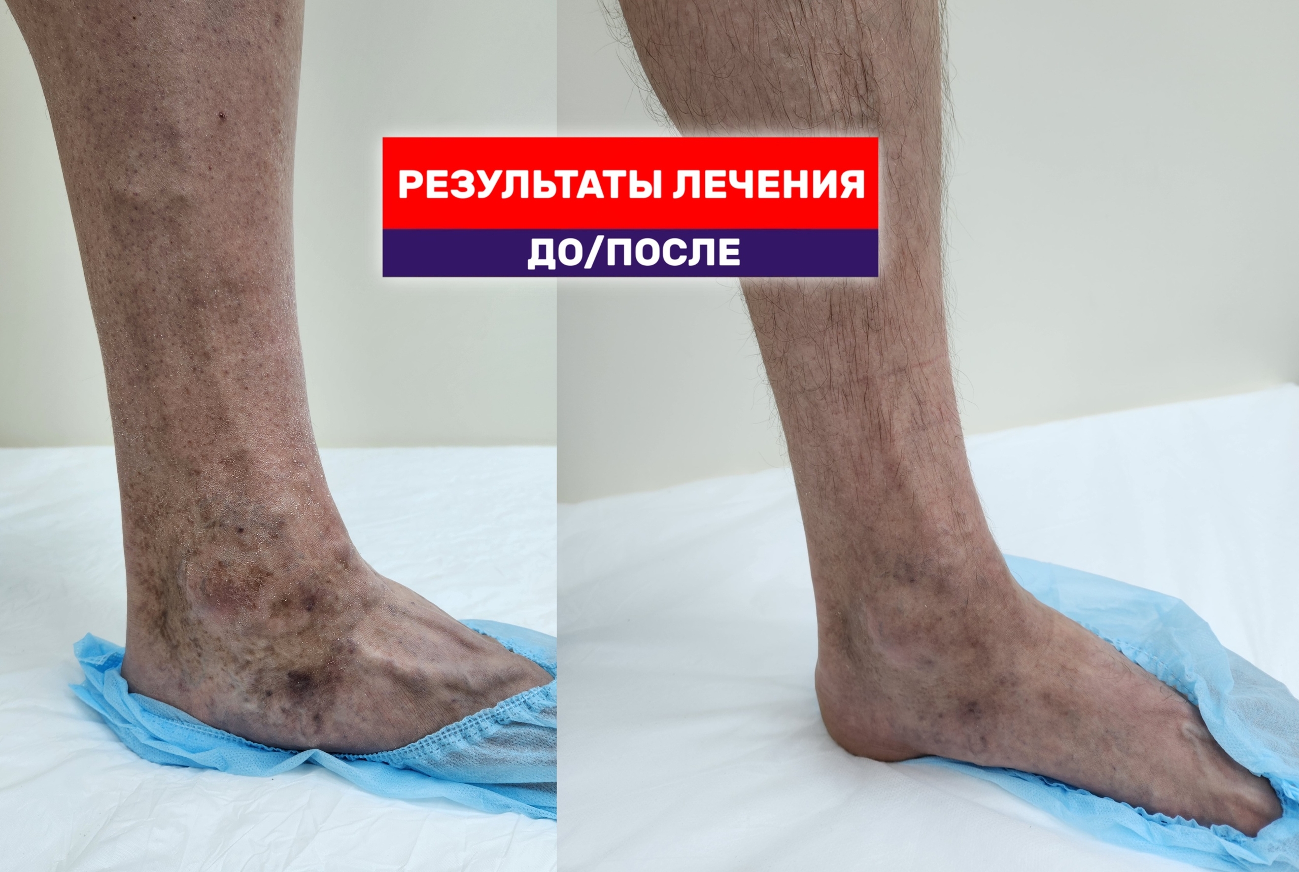 Выраженный магистральный «мужской» варикоз с вовлечением стопы. Результат лечения лазером